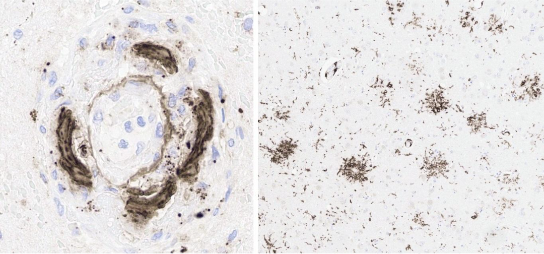 Caption: The most striking findings were the mononuclear attack on cerebral amyloid angiopathy (histiocytic vasculitis) with fibrinoid necrosis (left, Aβ immunohistochemistry [4G8]), and focally pronounced Aβ plaque phagocytosis (right, CD163 immunohistochemistry), the combination of which does not otherwise exist in nature. Credit: Journal of Alzheimer's Disease.